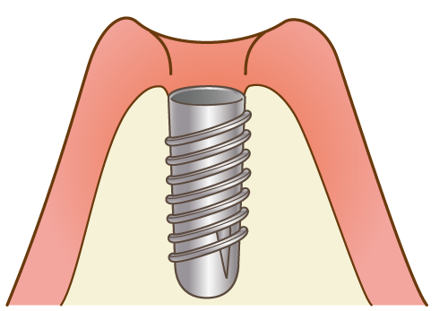 一次手術（インプラント埋入）